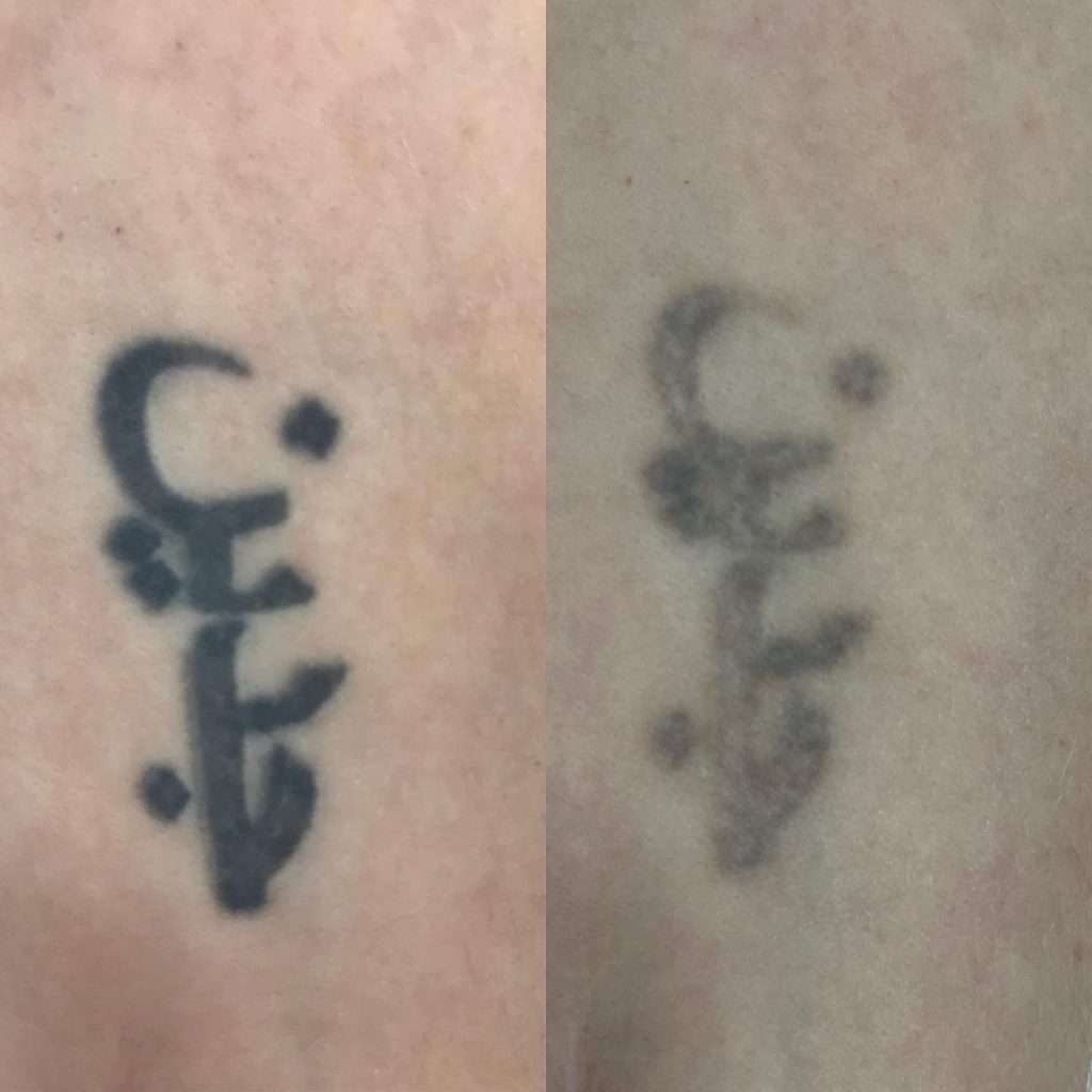 Professional tattoo removal session at simply scalp in south london targeting unwanted pigment.