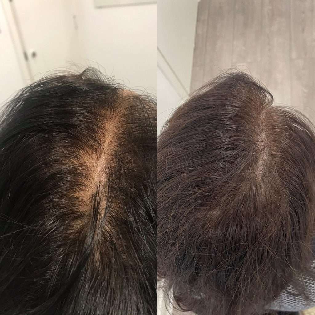Women’s scalp micropigmentation treatment at simply scalp in south london reducing the appearance of thinning hair.
