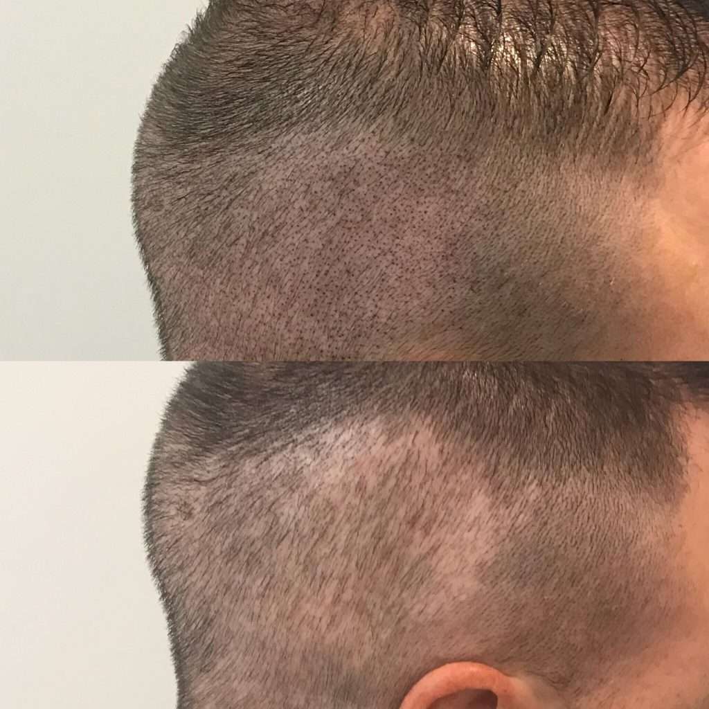 Before and after smp creating a natural shaved-head look at simply scalp purley.