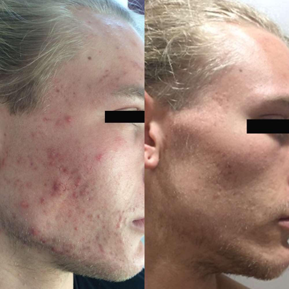 Visible improvement in acne-prone skin after led phototherapy treatment.
