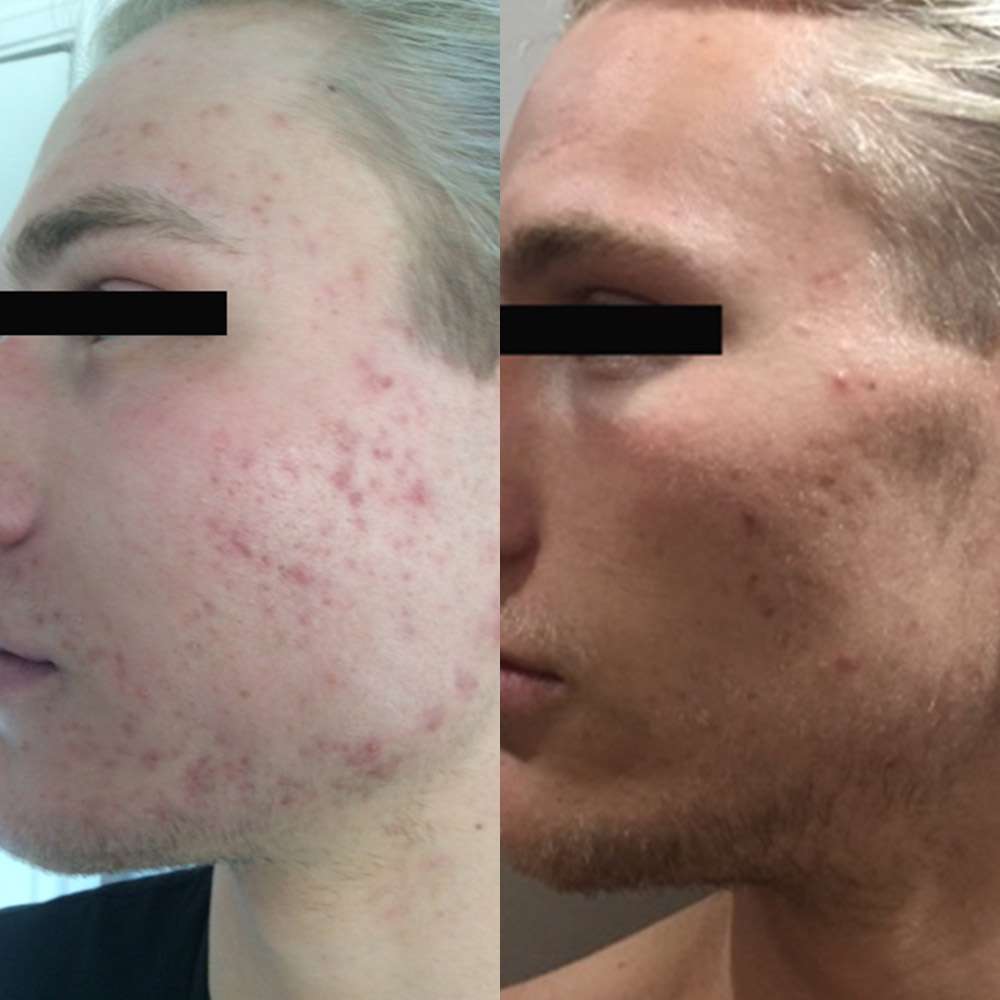 Side-by-side acne skin results following led light treatment.