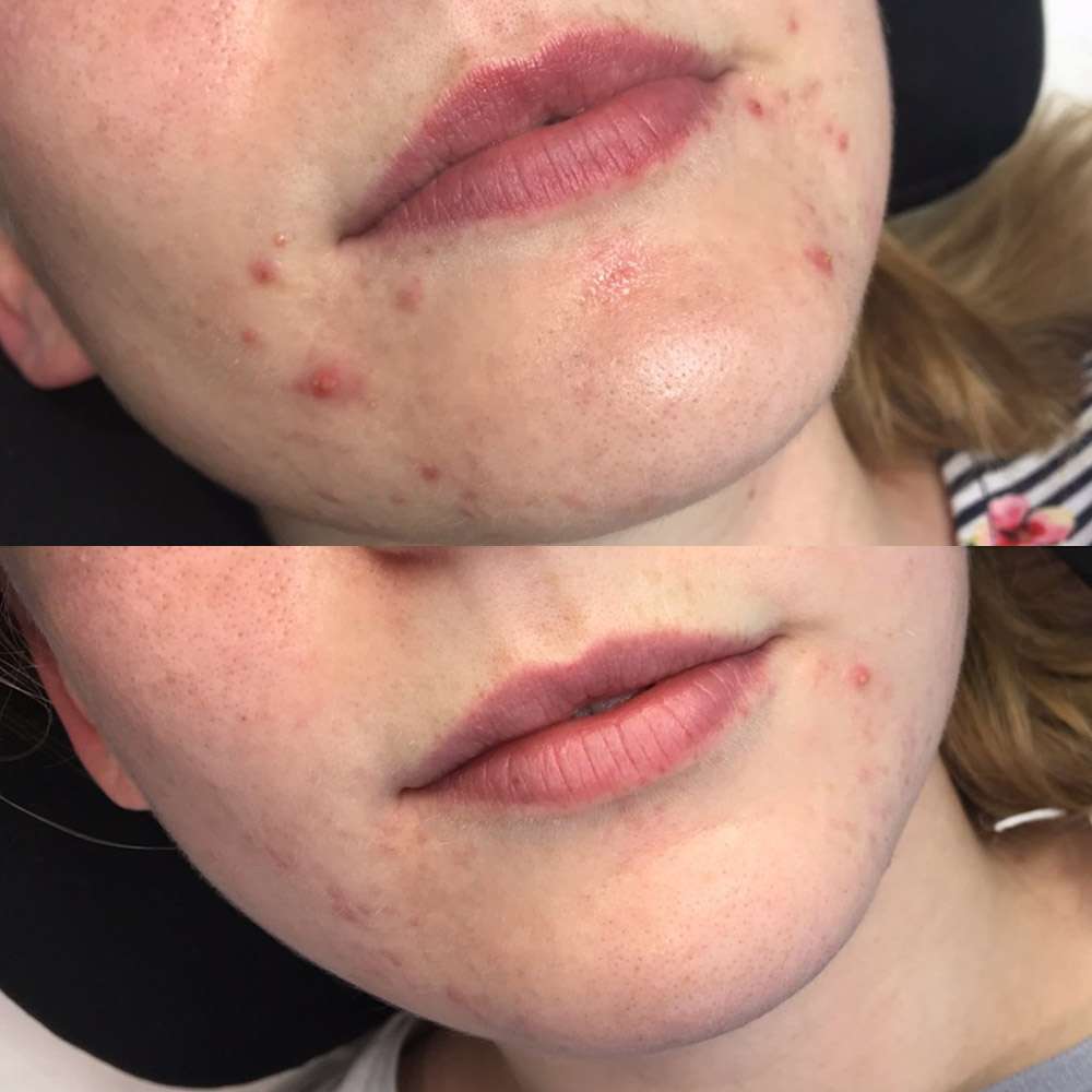 Led therapy reducing breakouts and inflammation on acne-prone skin.