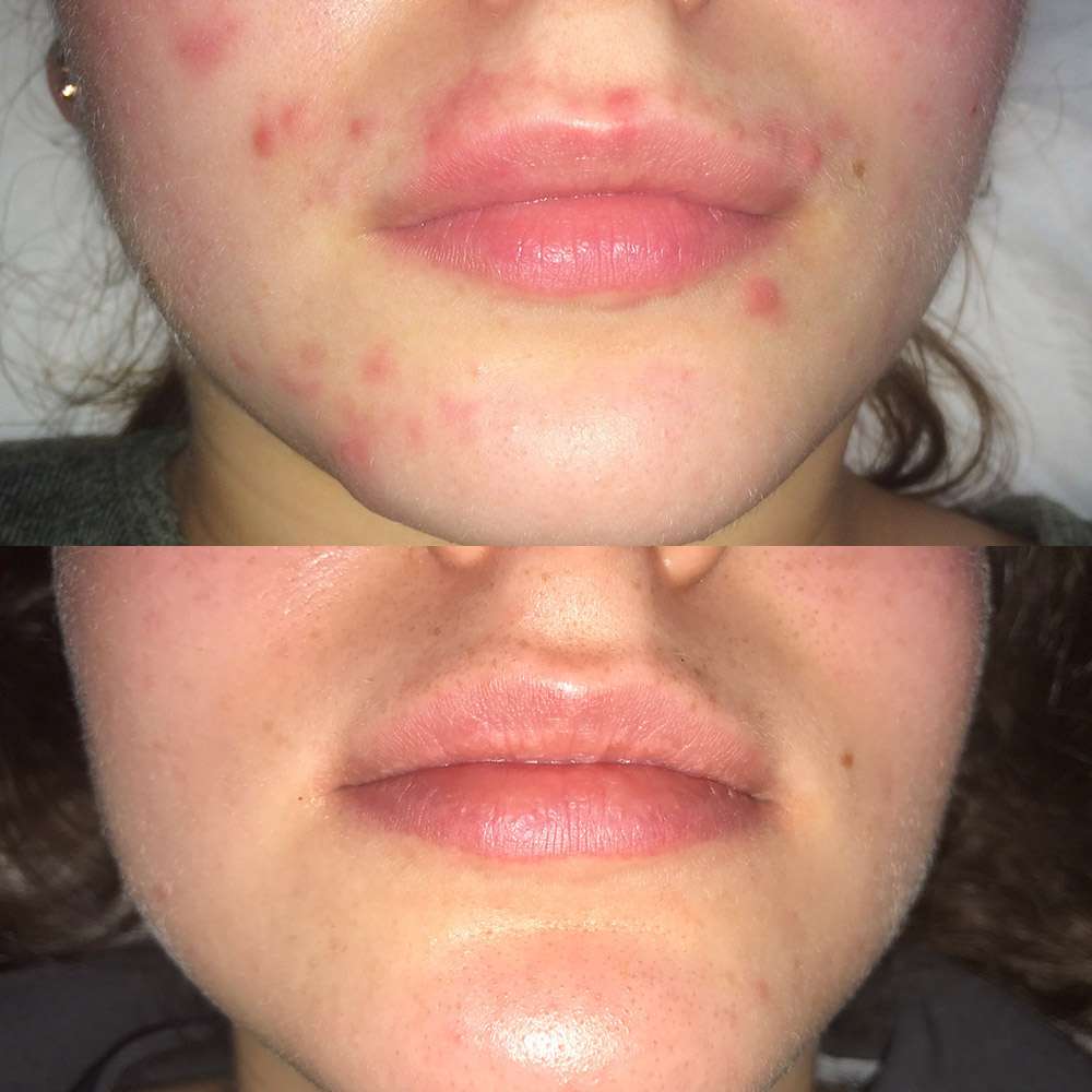Acne improvement using led phototherapy at simply scalp purley.
