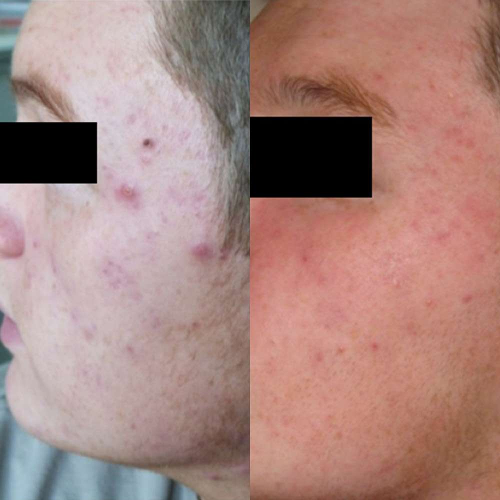 Before and after led treatment targeting active acne.