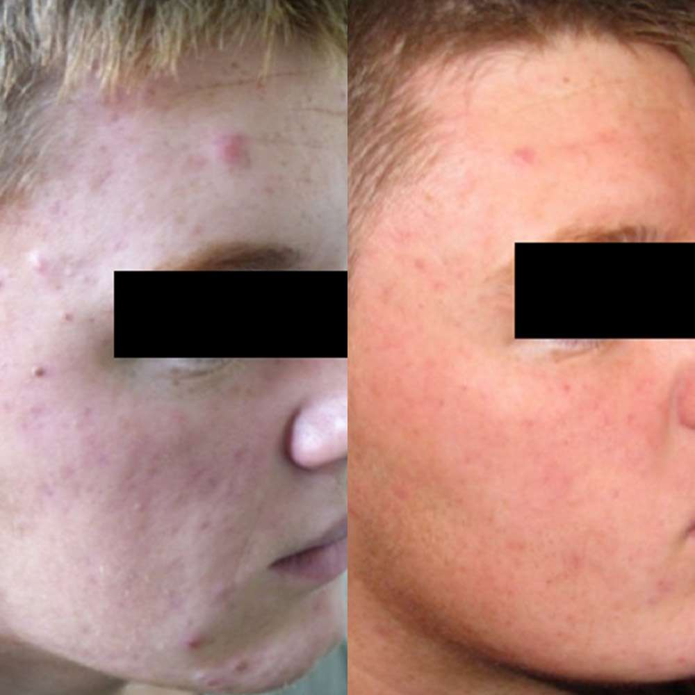 Clearer complexion following led light therapy for acne.