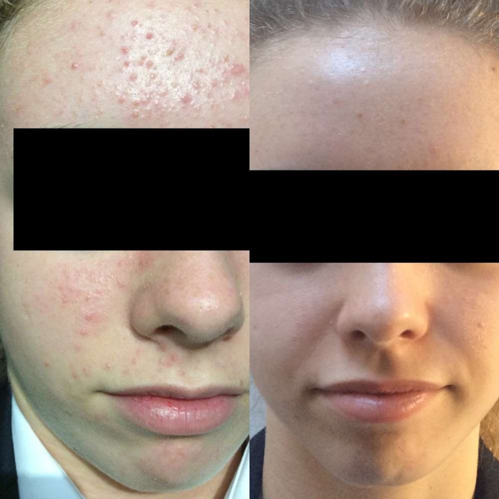 Reduced blemishes after led phototherapy treatment.