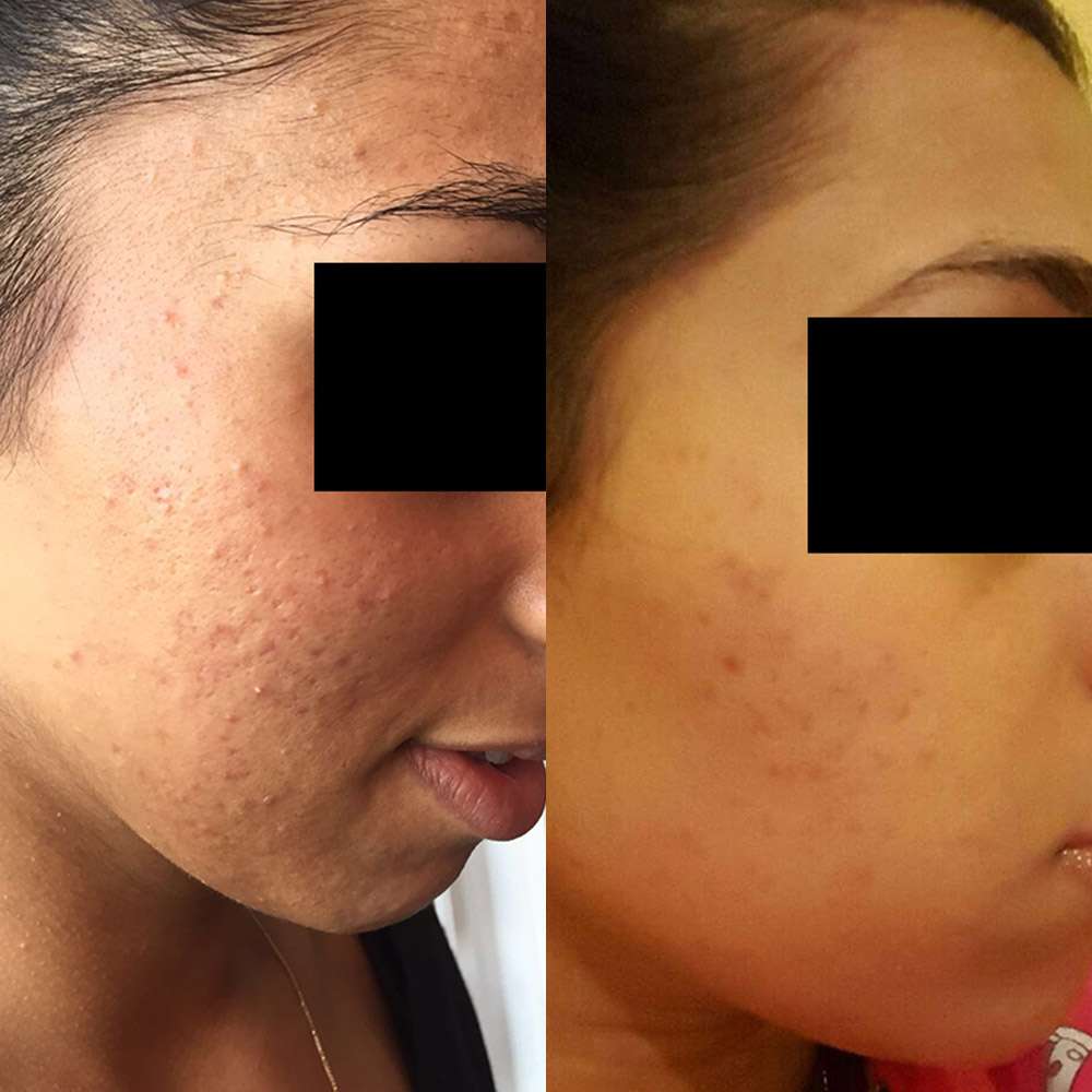 Acne-prone skin showing improvement after led sessions.
