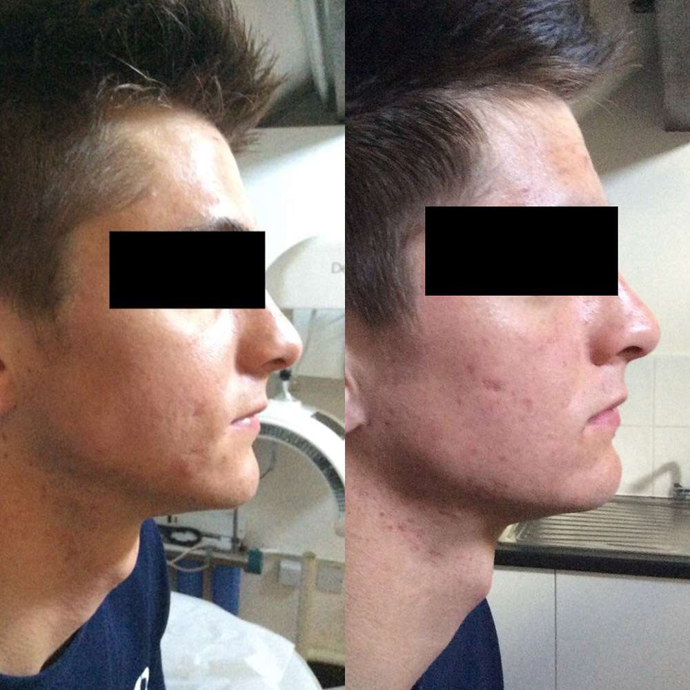Led phototherapy calming inflamed acne-prone skin in south london.