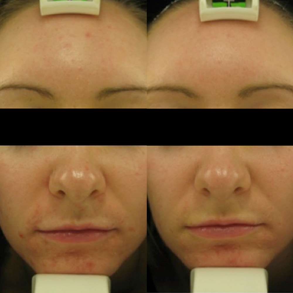 Before and after led phototherapy treatment for acne prone skin at simply scalp in purley, south london.