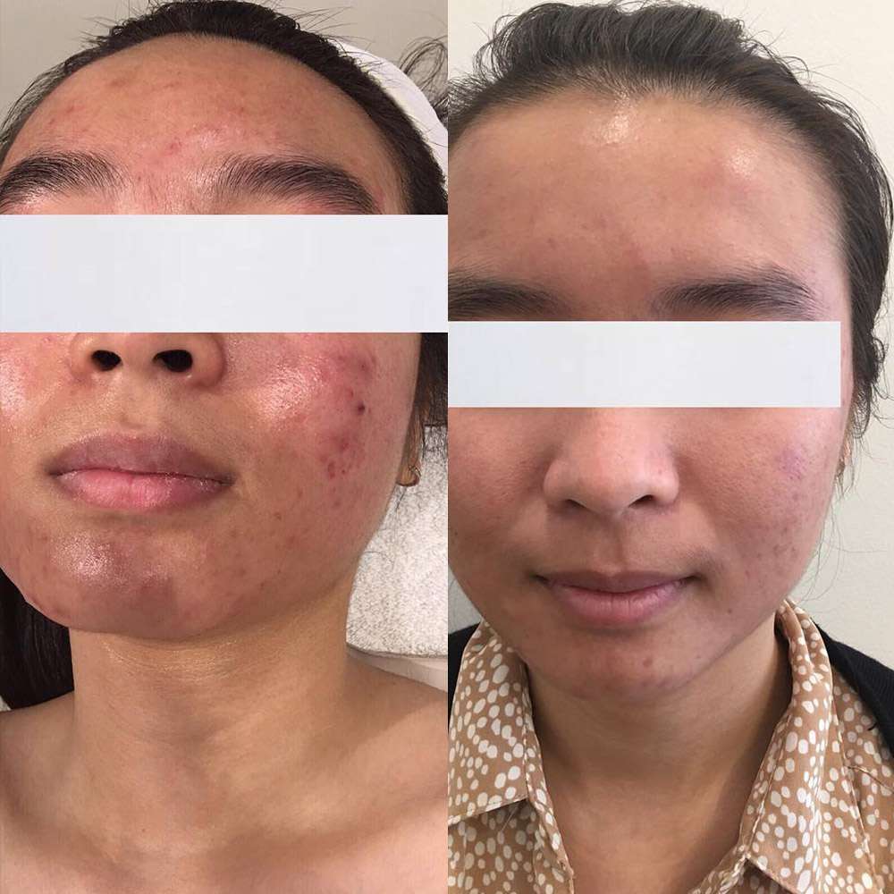 Led light therapy improving acne-prone skin clarity in purley, south london.