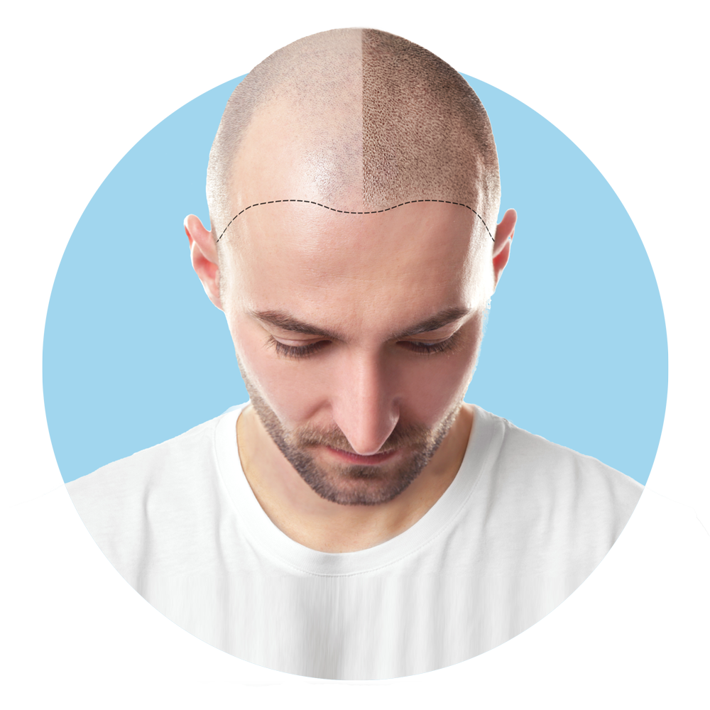 Bald man 1: simply scalp