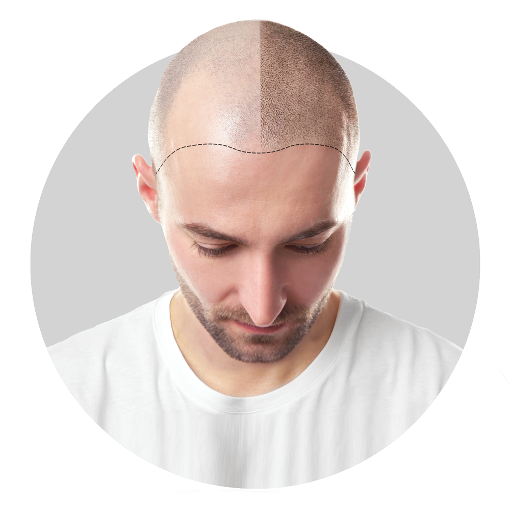 Why choose scalp micropigmentation at simply scalp in purley, south london for natural-looking hair restoration.