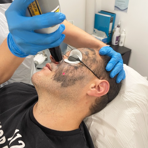 Client receiving a carbon facial at simply scalp in surrey, south london for deep skin rejuvenation.