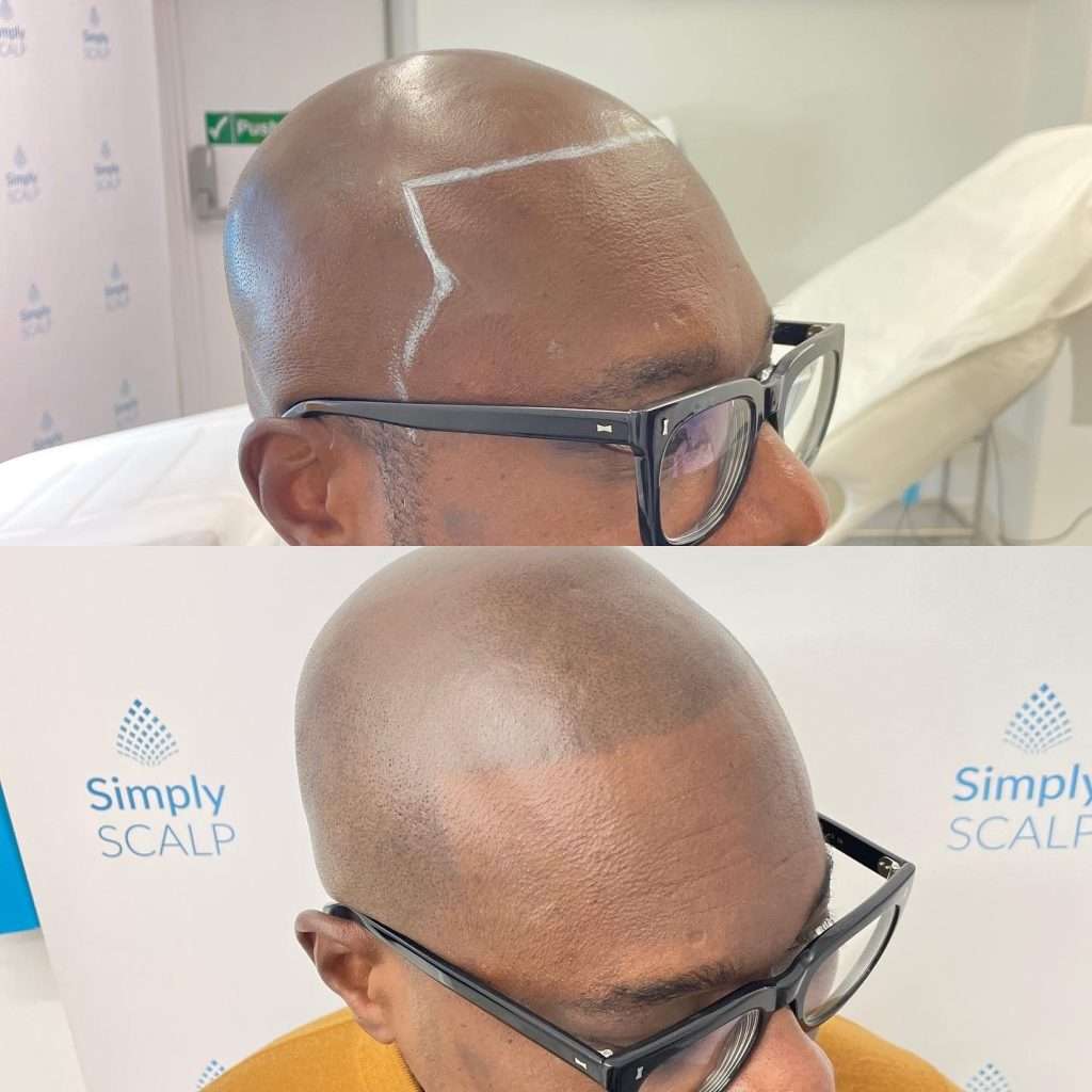 Before and after scalp micropigmentation results at simply scalp in purley, south london.