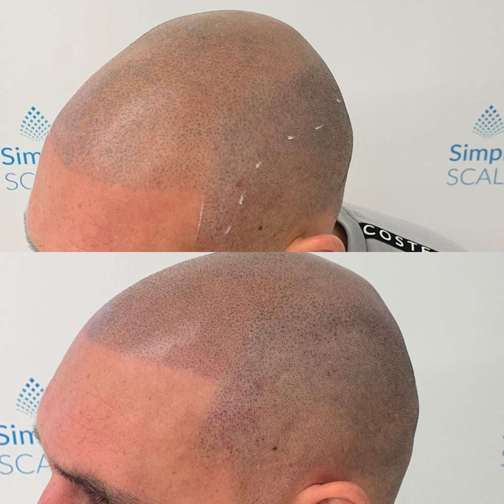 Scalp micropigmentation before and after demonstrating improved density and realism.