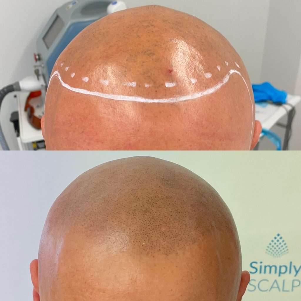 Side-by-side scalp micropigmentation transformation improving hairline definition.