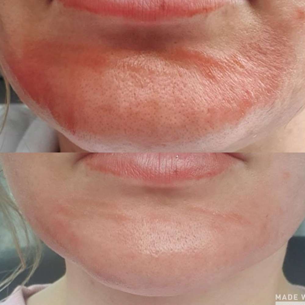 Skin recovery enhanced by led light therapy in south london.