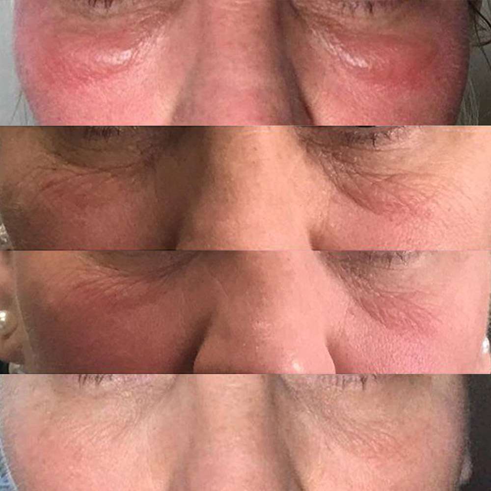 Before and after led therapy promoting faster skin healing.