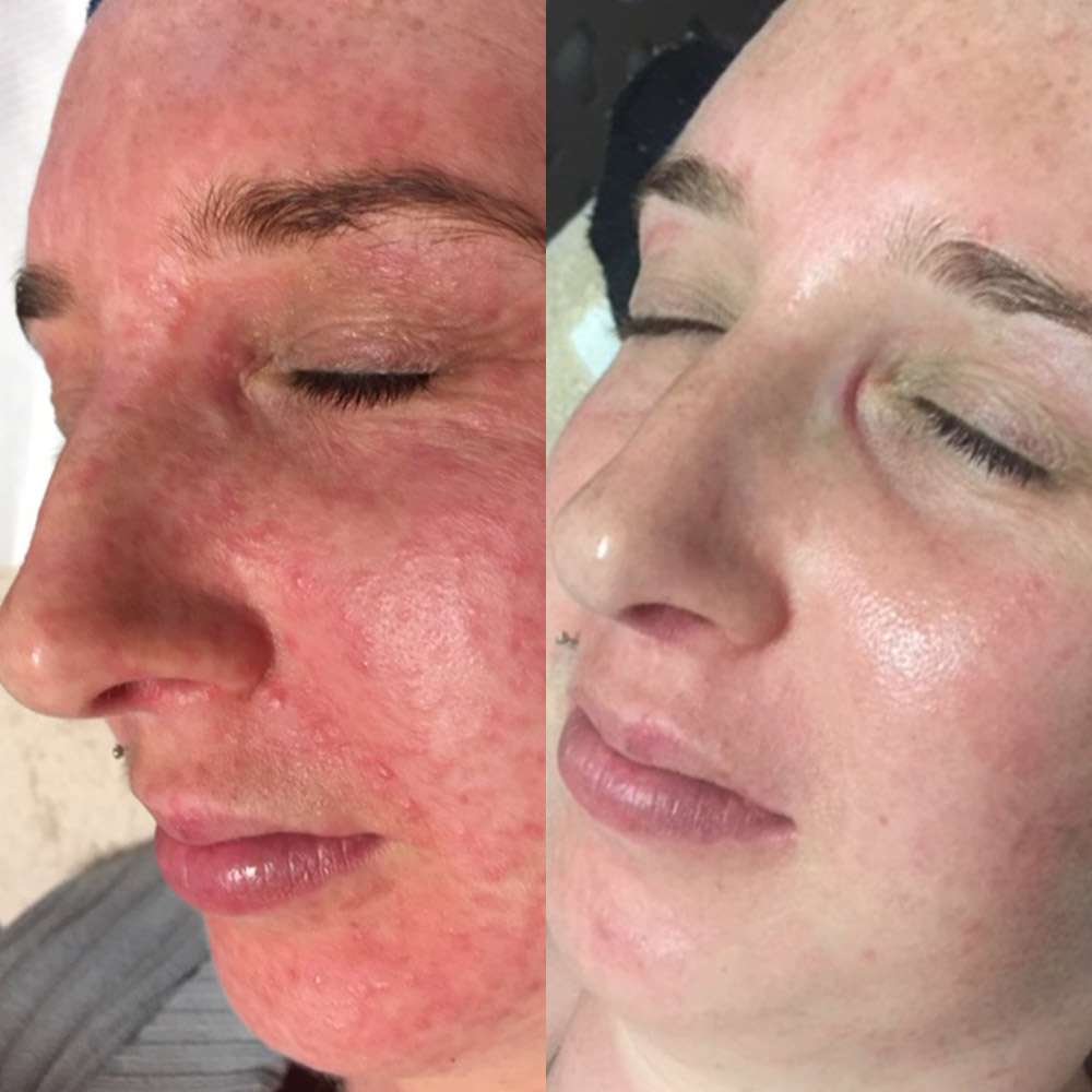 Led therapy soothing sensitive skin and redness in south london.