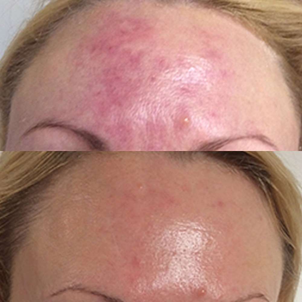 Visible reduction in redness after led phototherapy sessions.