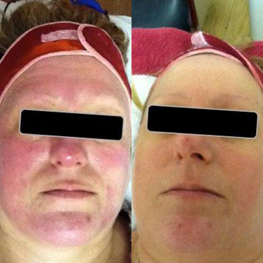 Led phototherapy reducing facial redness at simply scalp in purley.
