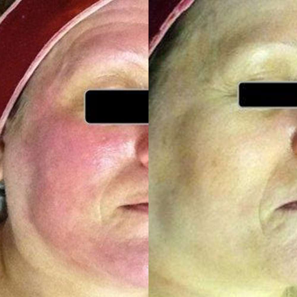 Before and after led light therapy calming irritated skin.