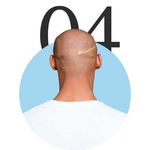 Scarring 04 icon: simply scalp Scarring 04 icon: simply scalp