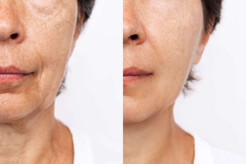 Professional microneedling procedure at simply scalp in south london promoting smoother, rejuvenated skin.