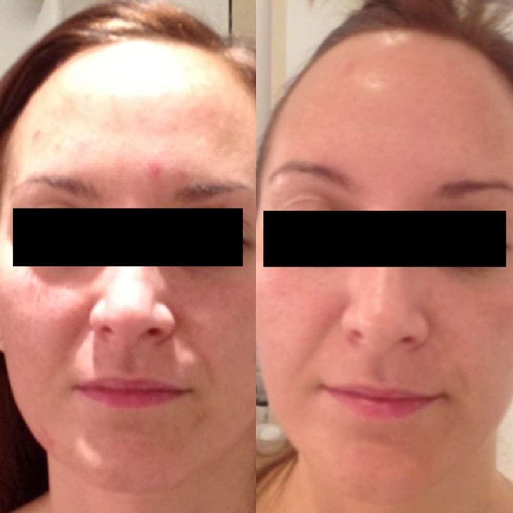 Side-by-side led treatment results enhancing skin radiance.