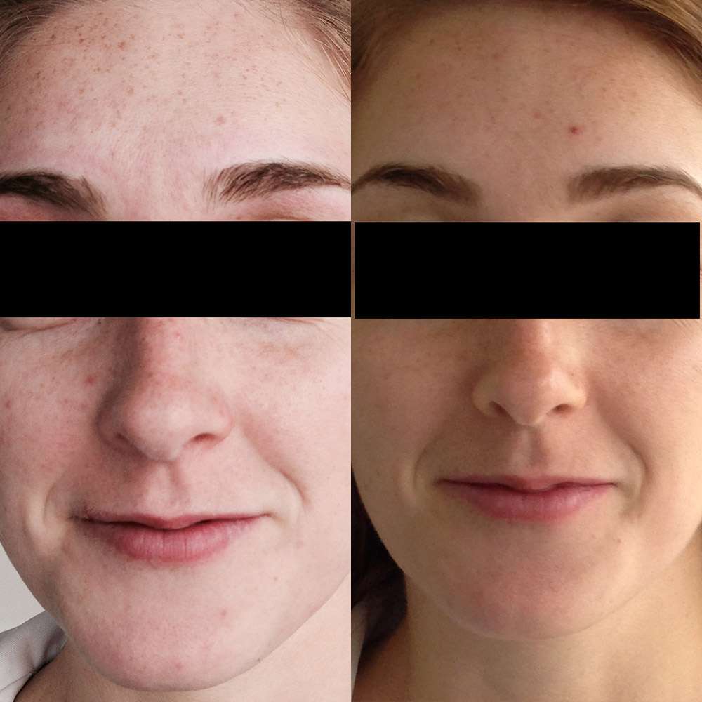 Improved skin clarity after led rejuvenation therapy in purley.
