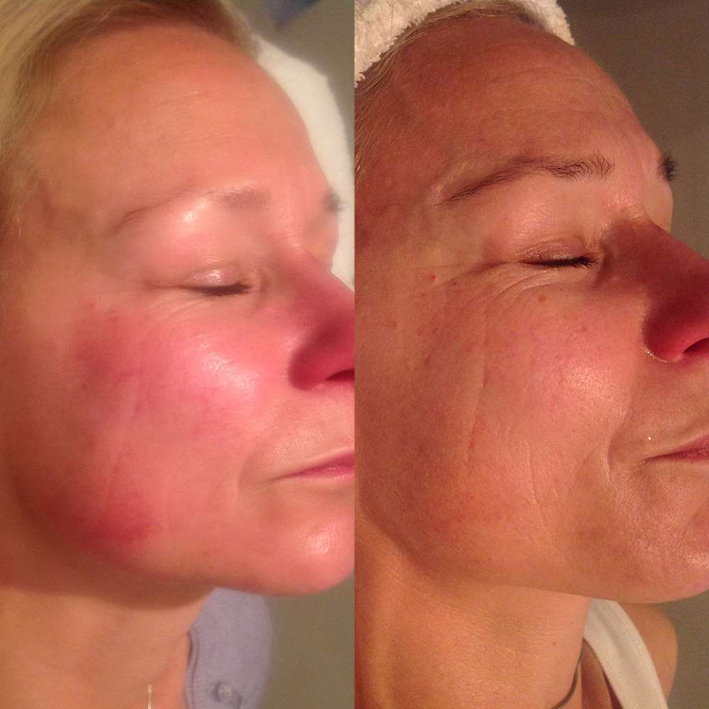 Before and after led phototherapy for skin rejuvenation at simply scalp purley.