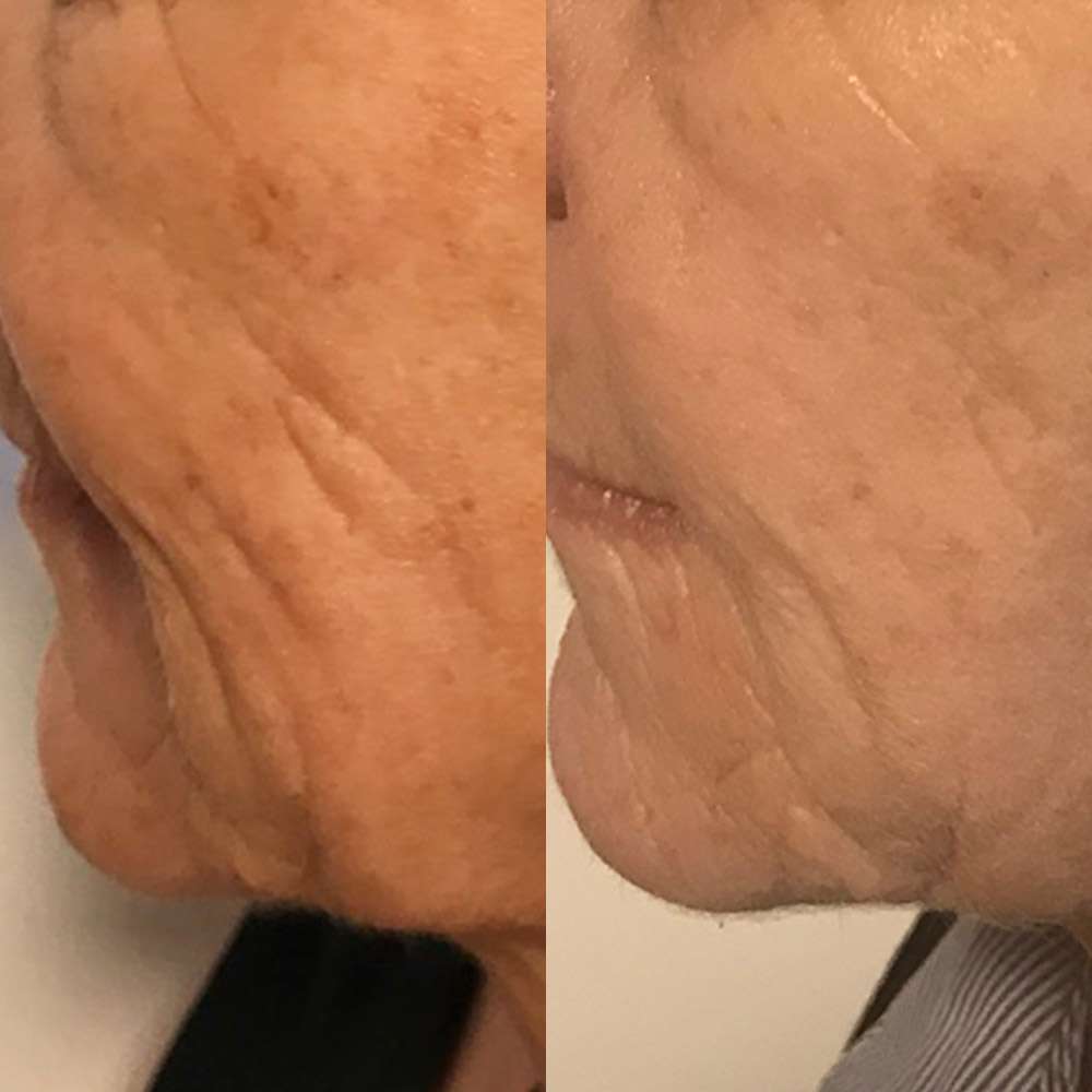 Led light therapy improving skin tone and texture in south london.