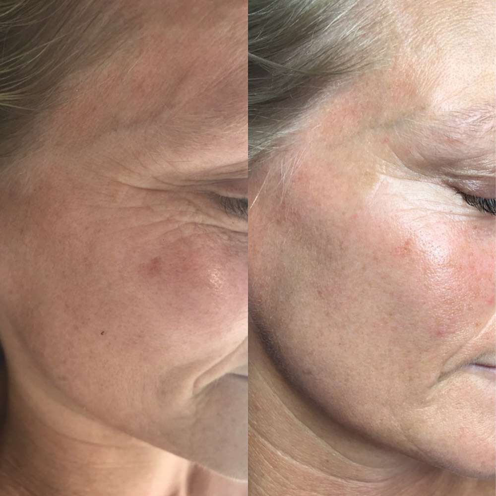 Brighter, refreshed skin following led phototherapy sessions.