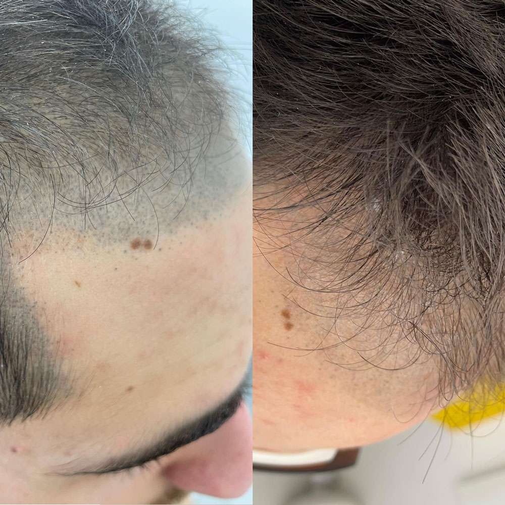 Laser smp removal session at simply scalp in south london correcting unwanted scalp pigmentation.