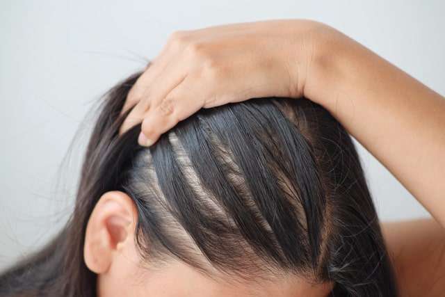 Before and after smp treatment for alopecia at simply scalp in south london.