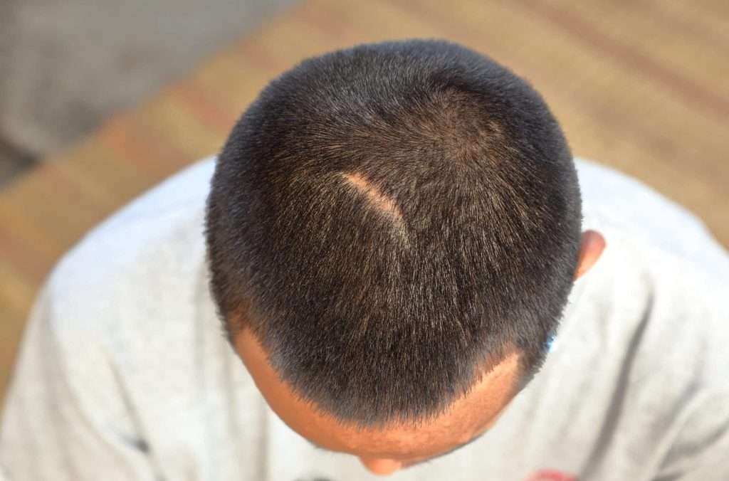 Smp treatment reducing the visibility of scalp scars at simply scalp in south london.