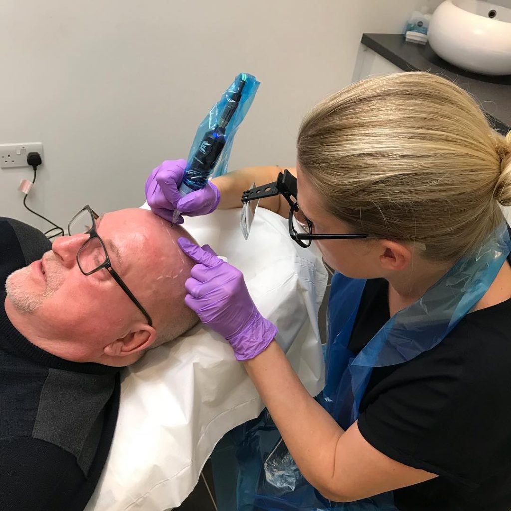 What is scalp micropigmentation a complete beginners guide: simply scalp
