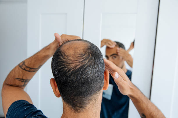 Smp vs. Hair transplants which hair loss solution is right for you: simply scalp