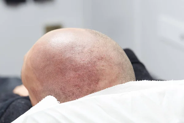 How much scalp micropigmentation pain should you actually expect: simply scalp