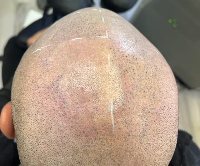 Are you tired of your smp want a new hairline or just want v0 tmuij0kjv9jb1 e1779090068804: simply scalp