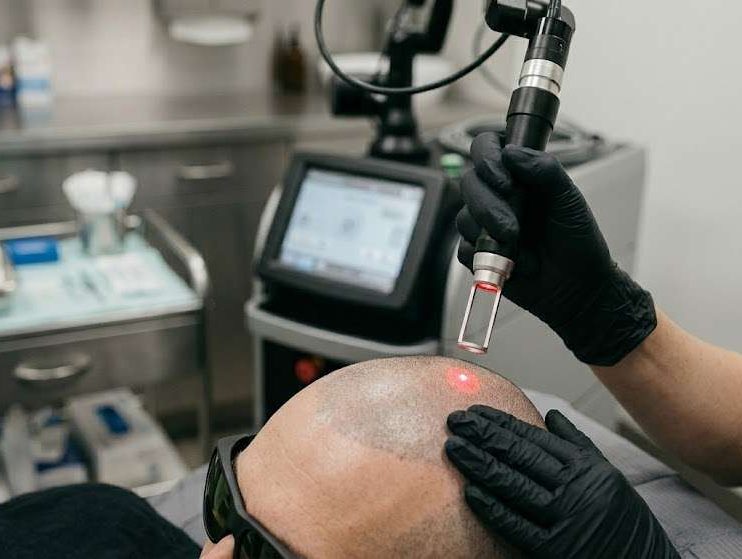 What makes nd yag laser so effective at removing smp pigment e1782289034574: simply scalp